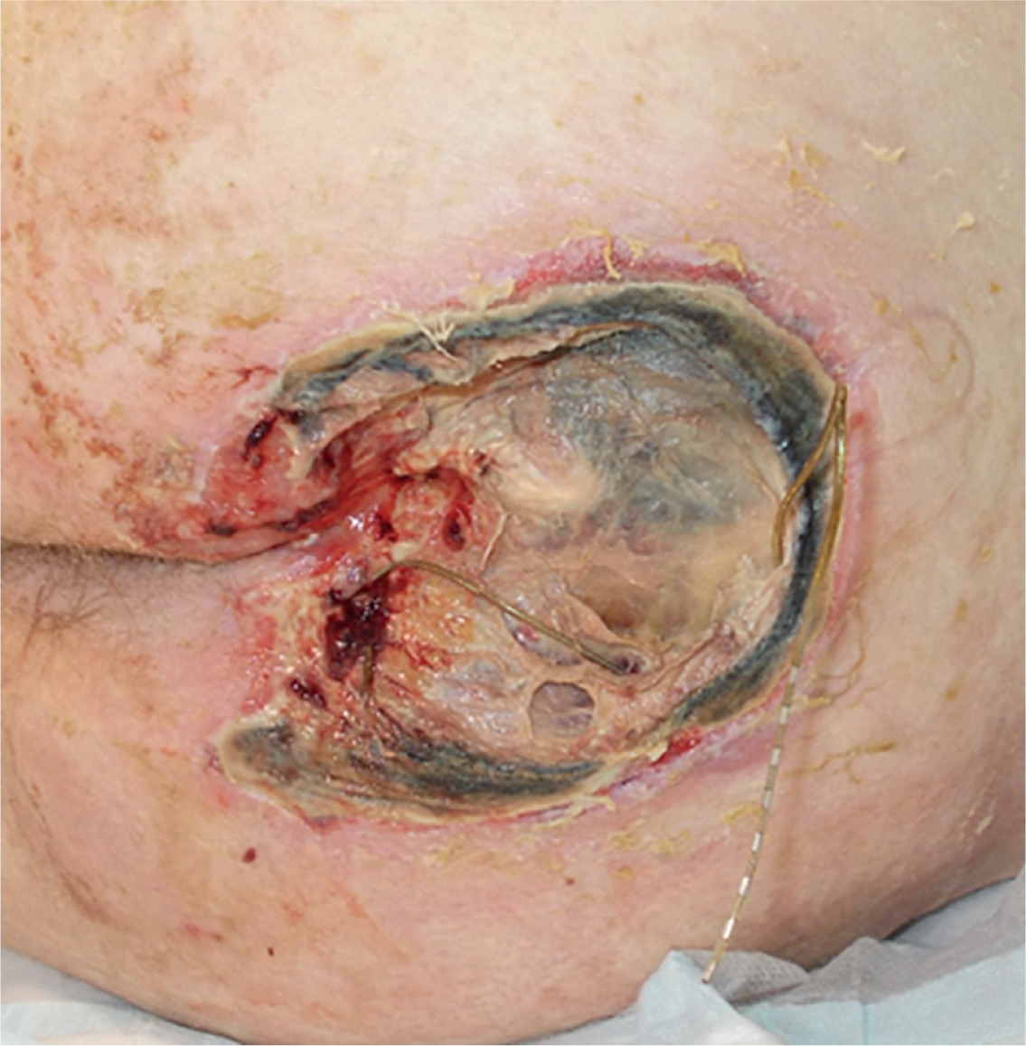 Wound Management for Medical Adhesive-Related Skin Injuries