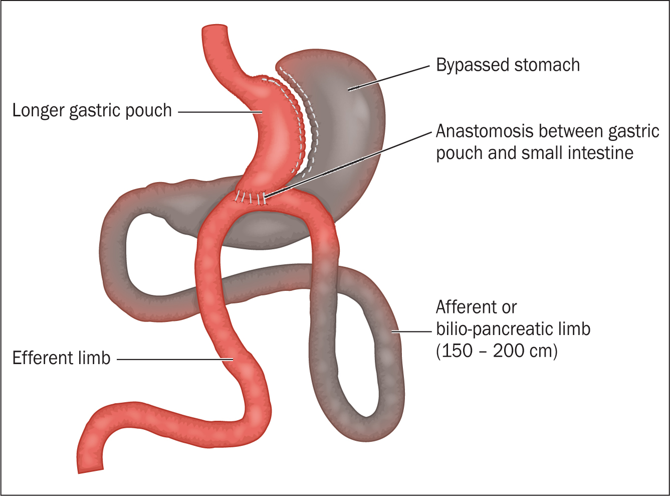 British Journal Of Nursing Care For Patients Who Have Undergone One Anastomosis Gastric Bypass